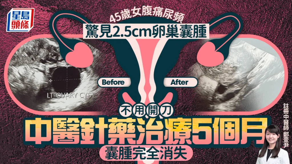 中醫治療五個月卵巢囊腫完全消失